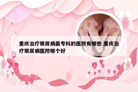 重庆治疗银屑病最专科的医院有哪些 重庆治疗银屑病医院哪个好