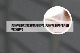 克拉霉素胶囊治银屑病吗 克拉霉素片对真菌有效果吗