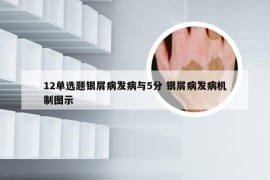 12单选题银屑病发病与5分 银屑病发病机制图示