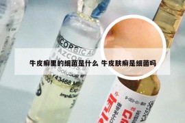 牛皮癣里的细菌是什么 牛皮肤癣是细菌吗