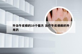 外治牛皮癣的10个偏方 治疗牛皮病癣的外用药