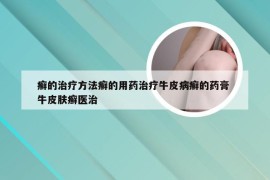 癣的治疗方法癣的用药治疗牛皮病癣的药膏 牛皮肤癣医治