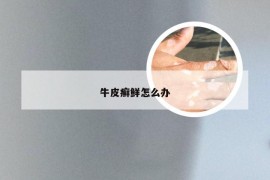 牛皮癣鲜怎么办