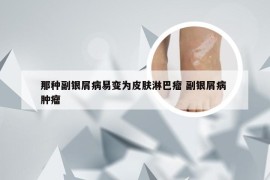 那种副银屑病易变为皮肤淋巴瘤 副银屑病 肿瘤