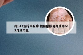 维B12治疗牛皮癣 银屑病服用维生素b12用法用量