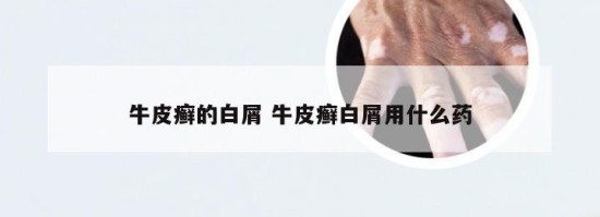 牛皮癣的白屑 牛皮癣白屑用什么药