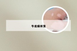 牛皮癣并发