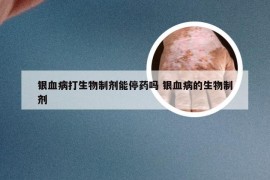 银血病打生物制剂能停药吗 银血病的生物制剂