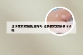 遗传性皮肤病能治好吗 遗传性皮肤病会传染吗