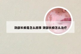 劲部长癣是怎么回事 颈部长癣怎么治疗