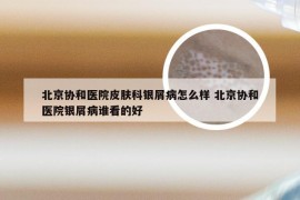 北京协和医院皮肤科银屑病怎么样 北京协和医院银屑病谁看的好