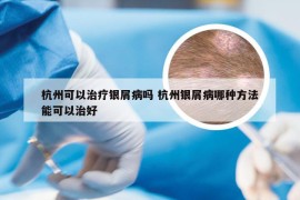 杭州可以治疗银屑病吗 杭州银屑病哪种方法能可以治好