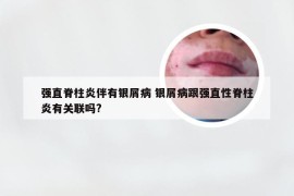 强直脊柱炎伴有银屑病 银屑病跟强直性脊柱炎有关联吗?