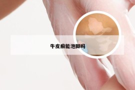 牛皮癣能泡脚吗