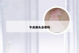 牛皮癣头会晕吗