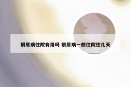 银屑病住院有用吗 银屑病一般住院住几天