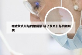 喉咙发炎引起的银屑病 嗓子发炎引起的银屑病