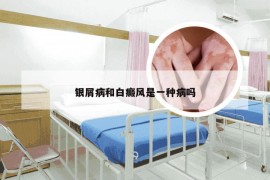 银屑病和白癜风是一种病吗