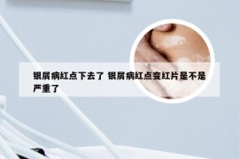 银屑病红点下去了 银屑病红点变红片是不是严重了