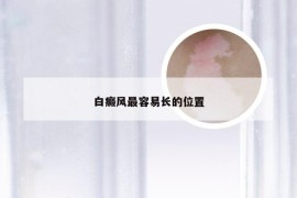 白癜风最容易长的位置