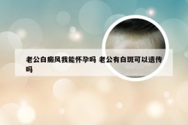 老公白癜风我能怀孕吗 老公有白斑可以遗传吗