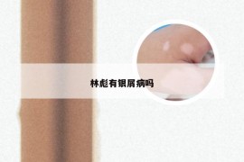 林彪有银屑病吗