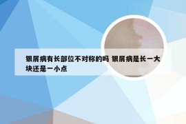 银屑病有长部位不对称的吗 银屑病是长一大块还是一小点