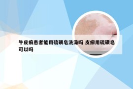 牛皮癣患者能用硫磺皂洗澡吗 皮癣用硫磺皂可以吗