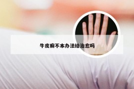 牛皮癣不本办法给治愈吗