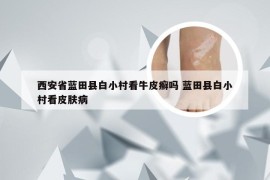 西安省蓝田县白小村看牛皮癣吗 蓝田县白小村看皮肤病