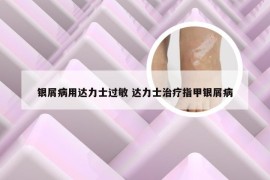 银屑病用达力士过敏 达力士治疗指甲银屑病
