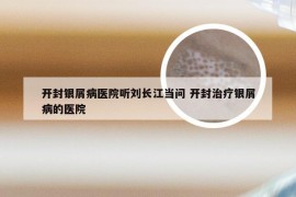 开封银屑病医院听刘长江当问 开封治疗银屑病的医院