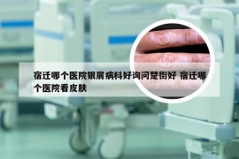 宿迁哪个医院银屑病科好询问楚街好 宿迁哪个医院看皮肤