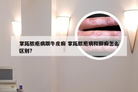 掌跖脓疱病跟牛皮癣 掌跖脓疱病和脚癣怎么区别?