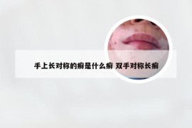 手上长对称的癣是什么癣 双手对称长癣