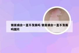 银屑病会一直不发展吗 银屑病会一直不发展吗图片