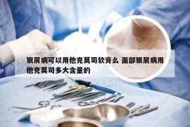 银屑病可以用他克莫司软膏么 面部银屑病用他克莫司多大含量的