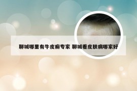 聊城哪里有牛皮癣专家 聊城看皮肤病哪家好