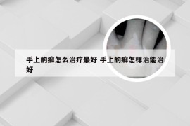 手上的癣怎么治疗最好 手上的癣怎样治能治好