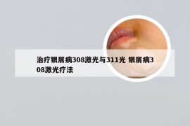 治疗银屑病308激光与311光 银屑病308激光疗法