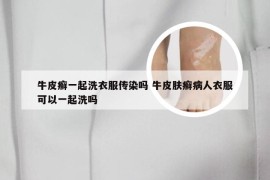 牛皮癣一起洗衣服传染吗 牛皮肤癣病人衣服可以一起洗吗