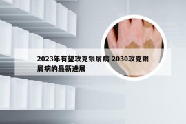 2023年有望攻克银屑病 2030攻克银屑病的最新进展