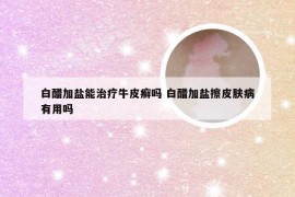 白醋加盐能治疗牛皮癣吗 白醋加盐擦皮肤病有用吗