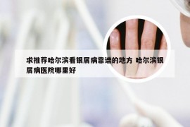 求推荐哈尔滨看银屑病靠谱的地方 哈尔滨银屑病医院哪里好