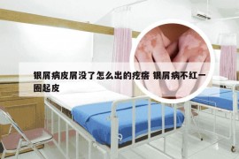 银屑病皮屑没了怎么出的疙瘩 银屑病不红一圈起皮