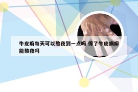 牛皮癣每天可以熬夜到一点吗 得了牛皮病癣能熬夜吗