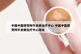 中国中医研究所牛皮癣治疗中心 中国中医研究所牛皮癣治疗中心地址