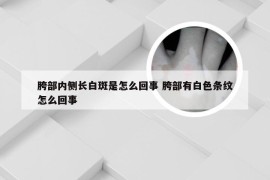 胯部内侧长白斑是怎么回事 胯部有白色条纹怎么回事