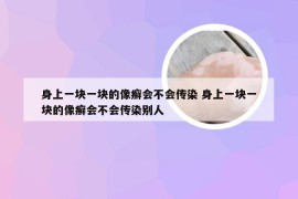 身上一块一块的像癣会不会传染 身上一块一块的像癣会不会传染别人