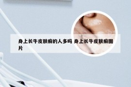 身上长牛皮肤癣的人多吗 身上长牛皮肤癣图片